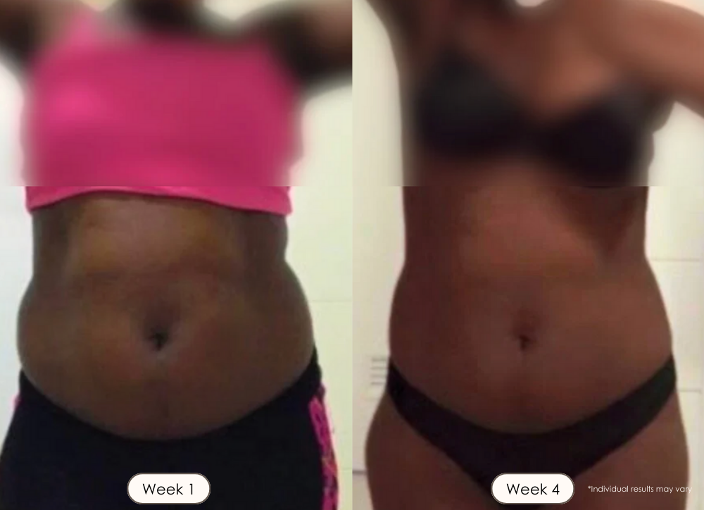 BodySculpt LED Radio frequency before and after results showing tighter slimmer abdomen