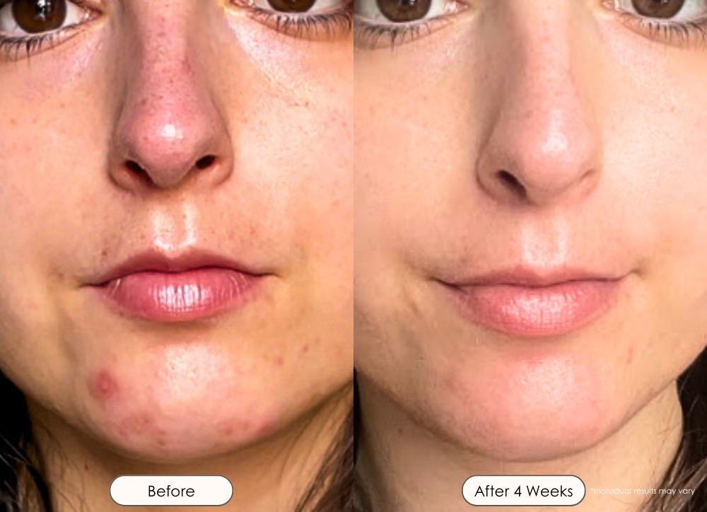 Faisca neon high frequency wand before and after where the face is visibly clearer and brighter after 4 weeks