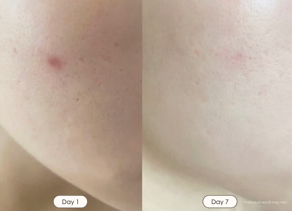 Lumamask Pro LED light therapy face mask before and after results showing smaller pores and reduced acne