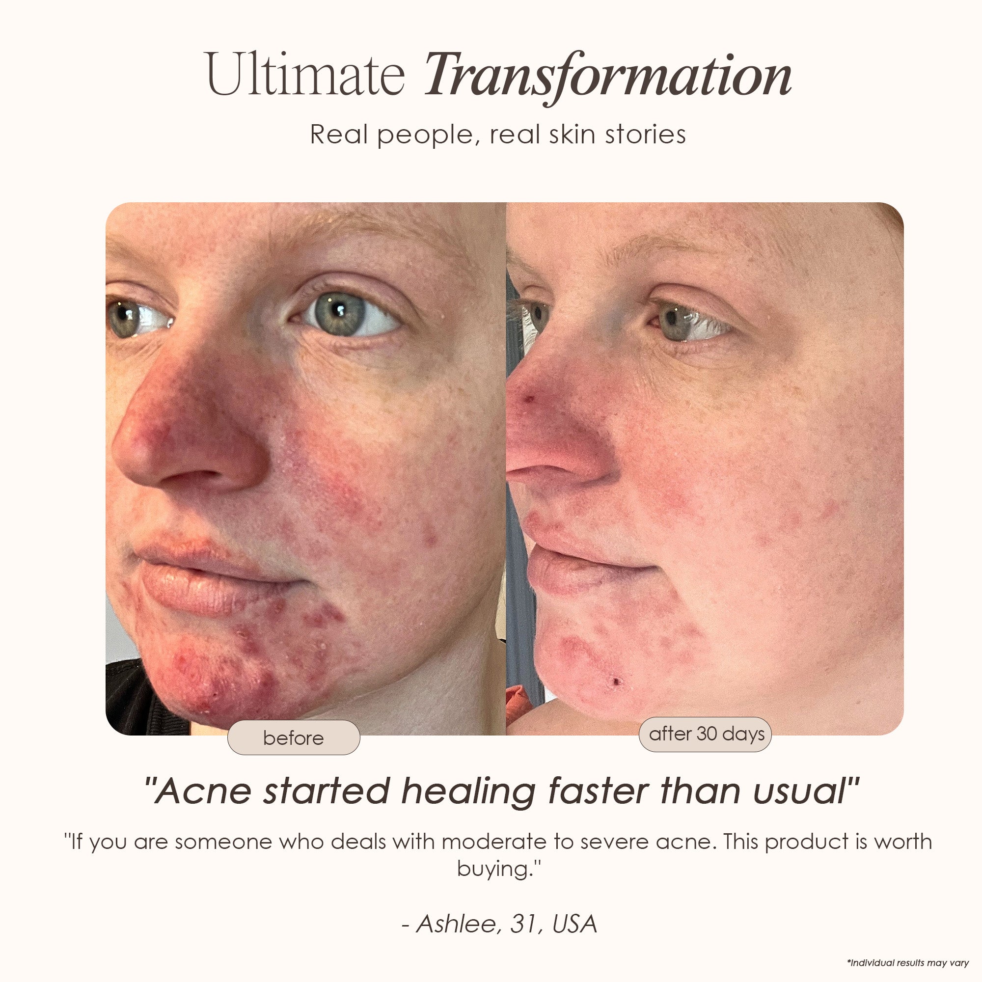 LightAura Plus LED face & neck mask before and after where acne healed faster after 30 days